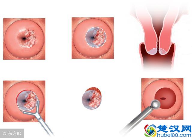 宫颈糜烂变化过程图片图片